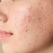 Wat kun je doen tegen acne