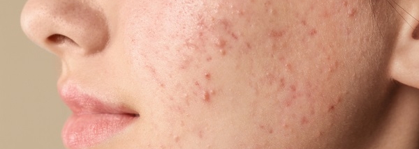 Wat kun je doen tegen acne