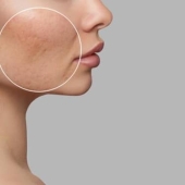 Herstel van binnenuit met medische lasertherapie